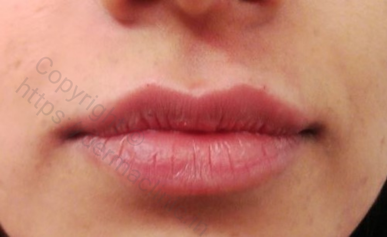 Lip Filler After