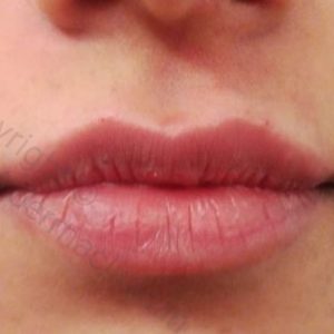 Lip Filler After